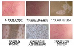 南通白癜风早期的症状表现是什么?